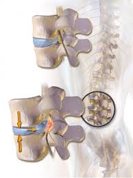Check spelling or type a new query. Herniated Disc Spinal Disc Herniation Symptoms And Diagnosis