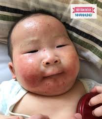 Trưởng khoa Nhi BV VNCuBa: Bột tắm Nhân Hưng trị chàm sữa rất hiệu quả