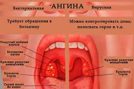 Virusnaya Angina U Detej Prichiny Zarazheniya Soputstvuyushie Simptomy I Sposoby Lecheniya Oficialnyj Sajt Gbuz Rodilnyj Dom 2 G Magnitogorsk
