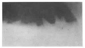 It commonly affects the terminal ileum and colon but may be seen anywhere from the mouth to anus. 2