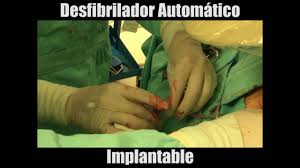 Un desfibrilador automático implantable (dai) es un producto sanitario implantable activo que puede detectar un ritmo cardíaco anómalo en un paciente y revertirlo automáticamente de un modo previamente programado, mediante la estimulación antitaquicardia o mediante descargas eléctricas. Desfibrilador Automatico Implantable Youtube