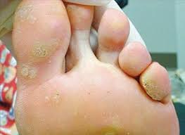The individual may also experience a sharp throbbing pain in the feet which may also be radiating. Those Painful Lumps On The Bottom Of Your Foot Are They Corns Or Verrucae Auckland Podiatry Clinic