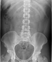 Typical Appearance Of A Ureteric Calculus Given The Relatively Small Size This Stone Would Be Expected To Pass Spontaneousl In 2020 Radiology Radiology Imaging X Ray