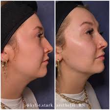 Kylie Thomson (Stark), RN, BSN (@kylie.stark_aesthetic_rn) • Instagram  photos and videos