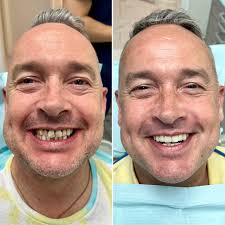One of my fun Friday smile makeover cases. He is interviewing for a new job  next week and needed his smile fixed ASAP. I started with quickly restoring  his 4 upper front