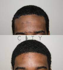 Scheduling a consultation to speak with a qualified it takes approximately seven to 10 days to recover from forehead reduction surgery, and your doctor will likely advise you to refrain from strenuous. Nyc Hairline Lowering Advancement New York Forehead Reduction Ues