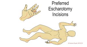 As nouns the difference between fasciotomy and escharotomy is that fasciotomy is (surgery) the cutting of the fascia to relieve tension or pressure (and treat the resulting loss of circulation to an area of tissue or muscle) while escharotomy is a surgical procedure in which an incision is made through eschar to expose the fatty tissue below. 5 Escharotomy Wheeless Textbook Of Orthopaedics