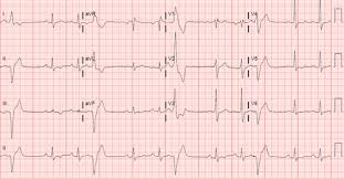 They are commonly found in people of all ages. Premature Ventricular Contraction Induced Cardiomyopathy Saurav 2015 Clinical Cardiology Wiley Online Library