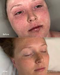 𝐍𝐨𝐭𝐡𝐢𝐧𝐠 𝐢𝐬 𝐰𝐨𝐫𝐤𝐢𝐧𝐠 𝐟𝐨𝐫 𝐲𝐨𝐮𝐫 𝐞𝐜𝐳𝐞𝐦𝐚  𝐚𝐧𝐲𝐦𝐨𝐫𝐞? 😣 💉 Dupilumab is an injectable that targets inflammation  from within, helping reduce redness, itch, and flare-ups, often in 2–4  weeks! For moderate to severe