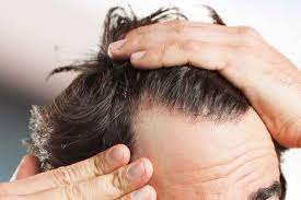 Masturbation or ejaculation seems to be the least of your concerns. Does Masturbation Cause Hair Loss In Men The Truth Mensopedia