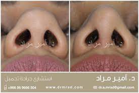 تجميل أرنبة الأنف عملية بسيطة تستغرق أقل من ساعة ونتيجتها تدوم إلى الأبد جراحة تجميل تجميل الانف تجميل الوجه الرياض السعودي nose ring septum ring septum