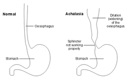Pathology Definition Achalasia Pathology Swallowing Problems Wholistic