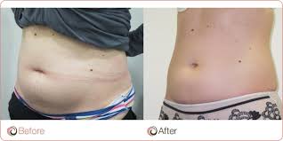 Coolsculpting Cosmos Clinic Adelaide