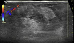 Image result for phlegmon of hand)