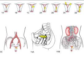 This rare form of cancer predominantly affects young children in central africa, but the disease has also been reported in other areas. Uterine Cancer Picture Image On Medicinenet Com
