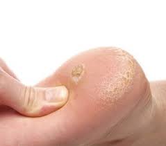 Image result for verruca