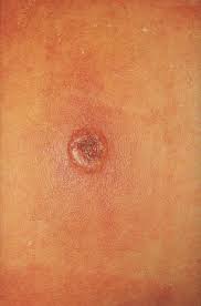 It's closely related to the vaccinia virus, which is used in the smallpox vaccine. References In Cowpox Virus Infection In An 11 Year Old Girl Journal Of The American Academy Of Dermatology