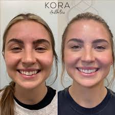 Botox Injections North Scottsdale, AZ