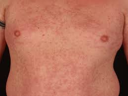 Various illnesses, such as mononucleosis, chickenpox, sixth disease, and measles, cause a viral rash. Virus Exanthema Overview Altmeyers Encyclopedia Department Dermatology