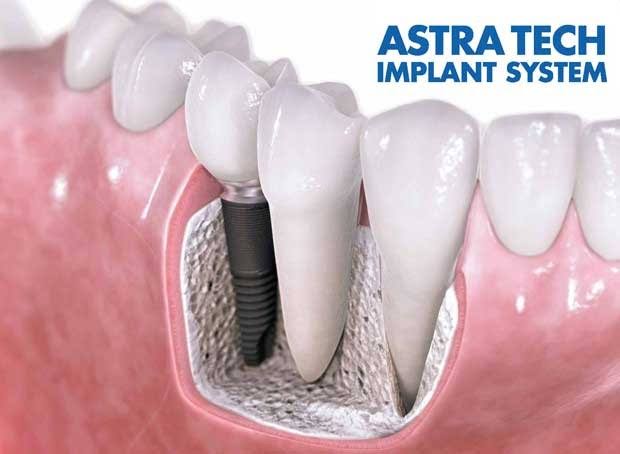Implant with Crown (Aztra Tech) -Yayla Dental Akademi Clinic İstanbul Bahçelievler