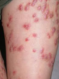 身上莫名起紅疹？蕁麻疹、對磨疹...8種紅疹照片、原因與改善方法一次公開- 良醫健康網