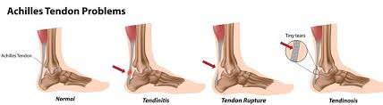 American orthopaedic foot & ankle society. Achilles Tendonitis Treatment Phoenix Insertional Tendinitis