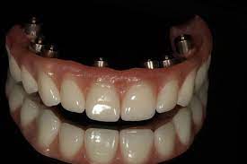 Implants Mitch Hurst Dental Studio Implant Dentistry Dental Dental Health