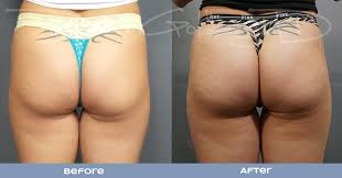 If you choose sculptra for your skin tightening needs. Sculptra Butt Lift I Plam Beach Butt Lift I Injectable Butt Lift I Bbl