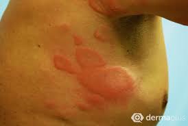 Meist bildet sich um die quaddeln herum ein erythem, das sogenannte reflexerythem. Nesselsucht Urtikaria Ursachen Und Therapie Derma Plus
