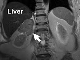 So when we go back to the image, you will notice that it can be difficult to find the nerve. X Rays Ct Scans Mri And Other Tests For Adrenal Glands
