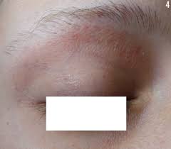 They usually don't cause concern, but there are some instances in which petechiae could indicate a more serious health problem. Telltale Petechiae And Bruises Abusive Strangulation Of An Adolescent Girl Consultant360