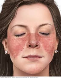 Image result for red rash face