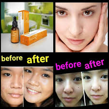 Kekurangan vitamin c akan melambatkan proses luka sembuh. Serum Vitamin C Original Resmi Bpom Kulit Putih Hilangkan Flek Bekas Jerawat Halus Kinclong Shopee Indonesia