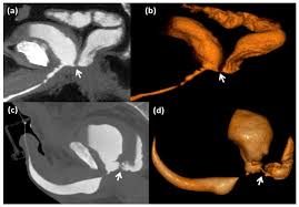 Image result for Retrograde Urethrogram