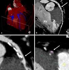 Maybe you would like to learn more about one of these? Einsatz Der Dual Source Computertomographie In Der Pra Und Postoperativen Kardiochirurgischen Diagnostik Springerlink