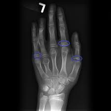 Growth hormone deficiency (ghd), or human growth hormone deficiency, is a medical condition resulting from not enough growth hormone (gh). Growth Hormone Deficiency X Ray Wikidoc