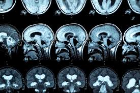 Image result for Hydrocephalus