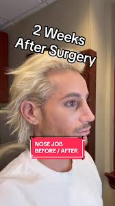Frankie Grande Nose Job Transformation