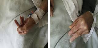Dianjurkan bagi anda untuk menemui dokter jika sering mengalami kesemutan, nyeri pada otot tangan dan kaki, atau otot melemah secara progresif dari bagian tubuh bawah menjalar ke atas. Guillain Barre Syndrome Related To Nivolumab Case Report Of A Patient With Urothelial Cancer And Review Of The Literature Clinical Genitourinary Cancer