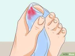 3 Ways To Treat A Torn Toenail Wikihow