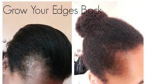 How To Grow Your Edges Back Natural Hair Styles Edges Hair Bald Hair