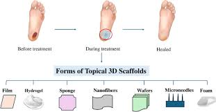 Image result for IDSA Diabetic Foot Wound Classification