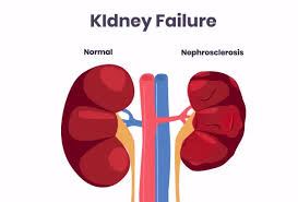 Image result for Postrenal Failure