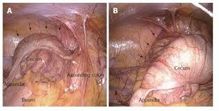 Surgery To Treat Symptomatic Mobile Cecum Syndrome Is Safe And Associated  With Good Recovery Outcomes - Cesaretti - 2018 - Case Reports In  Gastrointestinal Medicine - Wiley Online Library