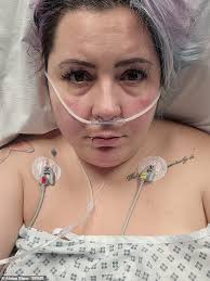London woman, 33, nearly killed by £4.5k gastric balloon that got 'stuck'  in her bowel