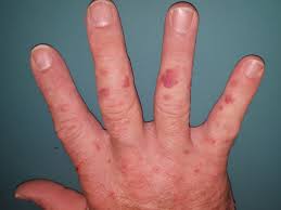 Cleaned something (not the toilet) using toilet bowl cleaner on sunday, and stupidly didn't consider the fact that the harsh chemicals shouldn't touch my hands. Spray Foam Insulation Chemical Burns Texas Tpreia Home Inspectors Internachi Forum
