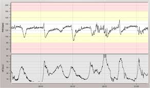 record of fetal heart rate fhr and uterine contractions