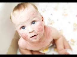 pin on alerjik bebek ve cocuklarda cilt bakimi