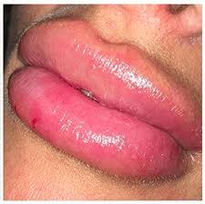 Prior to injecting the filler into the lips, the patient's medical history must be reviewed, and a facial. Lip Fillers Gone Wrong Dissolve Filler With Hyalase Advice Cost