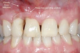 Periodontal Disease And Bone Loss Case Study Shaun Portland Perio Implant Center